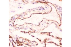 IHC-P: Collagen IV antibody testing of human lung cancer tissue (COL4A1 抗体  (AA 1445-1669))