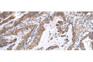 Immunohistochemistry of paraffin-embedded Human esophagus cancer tissue using WWP1 Polyclonal Antibody at dilution of 1:40(x200) (WWP1 抗体)