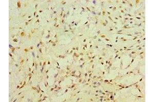 Immunohistochemistry of paraffin-embedded human breast cancer using ABIN7166493 at dilution of 1:100 (Ret Proto-Oncogene 抗体  (AA 29-300))