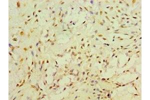 Immunohistochemistry of paraffin-embedded human breast cancer using ABIN7166493 at dilution of 1:100