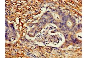 Immunohistochemistry of paraffin-embedded human colon cancer using ABIN7148889 at dilution of 1:100 (CDKN2C 抗体  (AA 1-68))