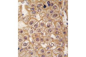 Formalin-fixed and paraffin-embedded human hepatocarcinoma tissue reacted with BAR2 Antibody  (ABIN391397 and ABIN2841401) , which was peroxidase-conjugated to the secondary antibody, followed by DAB staining. (BAR2 抗体  (AA 236-264))