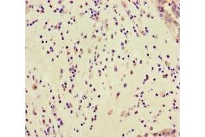 Immunohistochemistry of paraffin-embedded human lung cancer using ABIN7154798 at dilution of 1:100 (GAR1 抗体  (AA 1-217))