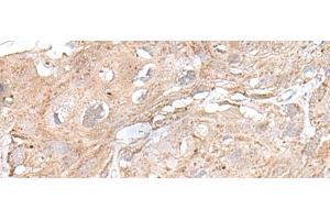 Immunohistochemistry of paraffin-embedded Human esophagus cancer tissue using SNRNP25 Polyclonal Antibody at dilution of 1:65(x200) (SNRNP25 抗体)