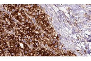 ABIN6272688 at 1/100 staining Human liver cancer tissue by IHC-P. (PTGER1 抗体  (Internal Region))