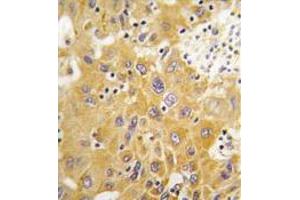 Formalin-fixed and paraffin-embedded human hepatocarcinoma tissue reacted with CAMK1-like Antibody (C-term) , which was peroxidase-conjugated to the secondary antibody, followed by DAB staining. (CAMK1D 抗体  (C-Term))