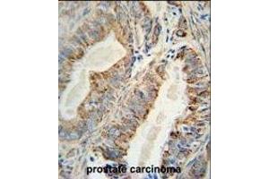 AKT2 Monoclonal Antibody (ABIN659024 and ABIN2838047) immunohistochemistry analysis in formalin fixed and paraffin embedded human prostate carcinoma followed by peroxidase conjμgation of the secondary antibody and DAB staining. (AKT2 抗体)