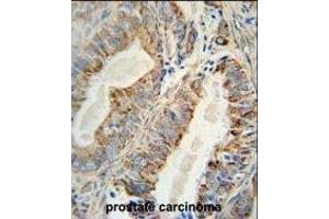 AKT2 Monoclonal Antibody (ABIN659024 and ABIN2838047) immunohistochemistry analysis in formalin fixed and paraffin embedded human prostate carcinoma followed by peroxidase conjμgation of the secondary antibody and DAB staining. (AKT2 抗体)