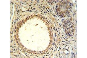 AMH antibody IHC analysis in formalin fixed and paraffin embedded prostate carcinoma. (AMH 抗体  (AA 424-451))