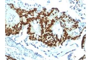 Immunohistochemical staining (Formalin-fixed paraffin-embedded sections) of human colon cancer with TP53 recombinant monoclonal antibody, clone TP53/1799R .