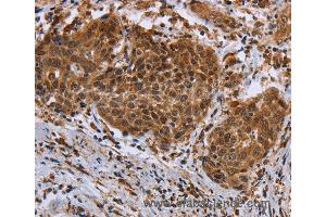 Immunohistochemistry of Human cervical cancer using DUSP8 Polyclonal Antibody at dilution of 1:30 (DUSP8 抗体)