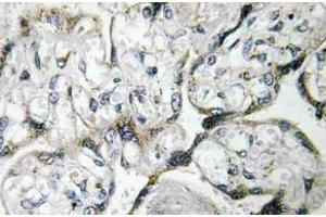 Immunohistochemistry (IHC) analyzes of PAKalpha antibody in paraffin-embedded human breast carcinoma tissue. (PAK1 抗体)