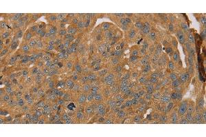 Immunohistochemistry of paraffin-embedded Human breast cancer tissue using PARP11 Polyclonal Antibody at dilution 1:30 (PARP11 抗体)