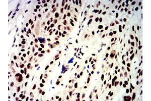 Immunohistochemical analysis of paraffin-embedded esophageal cancer tissues using APEX1 mouse mAb with DAB staining. (APEX1 抗体  (AA 219-318))