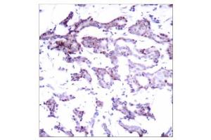 Immunohistochemical analysis of paraffin- embedded human breast carcinoma tissue using Elk-1 (Ab-389) antibody (E021037). (ELK1 抗体)