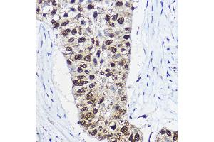 Immunohistochemistry of paraffin-embedded human lung cancer using SM Rabbit pAb (ABIN6132562, ABIN6148098, ABIN6148099 and ABIN6214424) at dilution of 1:100 (40x lens). (SMARCA1 抗体  (AA 1-200))