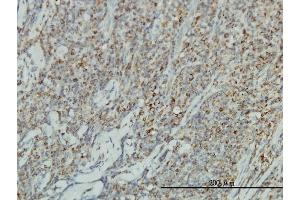Immunoperoxidase of monoclonal antibody to JUP on formalin-fixed paraffin-embedded human lymphoma tissue. (JUP 抗体  (AA 1-745))