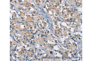 Immunohistochemistry of Human gastric cancer using GAS2 Polyclonal Antibody at dilution of 1:50 (GAS2 抗体)