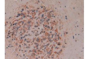 DAB staining on IHC-P; Samples: Human Lung cancer Tissue