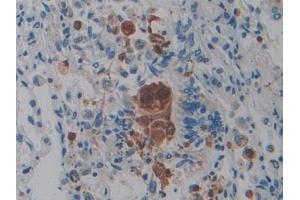 Detection of PTPRQ in Human Lung cancer Tissue using Polyclonal Antibody to Protein Tyrosine Phosphatase Receptor Type Q (PTPRQ) (PTPRQ 抗体  (AA 36-294))