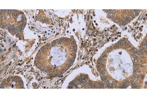 Immunohistochemistry of paraffin-embedded Human colon cancer using FKBP8 Polyclonal Antibody at dilution of 1:50