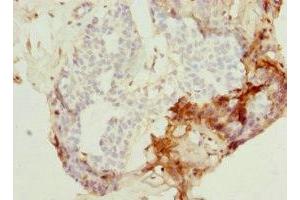 Immunohistochemistry of paraffin-embedded human breast cancer using ABIN7162990 at dilution of 1:100 (PEX7 抗体  (AA 1-240))
