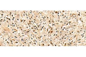 Immunohistochemistry of paraffin-embedded Human prost ate cancer tissue using PSMA3 Polyclonal Antibody at dilution of 1:50(x200) (PSMA3 抗体)