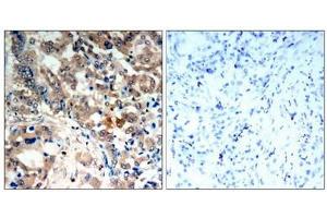 Immunohistochemical analysis of paraffin-embedded human lung carcinoma tissue, using AMPK-alpha,1/AMPK-alpha,2(Phospho-Thr174/Thr172) Antibody. (AMPK alpha 抗体  (pThr172, pThr183))