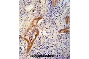 CLPX antibody (C-term) immunohistochemistry analysis in formalin fixed and paraffin embedded human hepatocarcinoma followed by peroxidase conjugation of the secondary antibody and DAB staining.