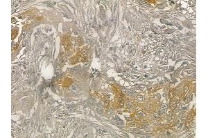 ABIN6262005 and ABIN6273249 at 1/100 staining human lung adenocarcinoma by IHC-P. (GMFG 抗体  (Internal Region))