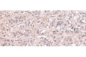 Immunohistochemistry of paraffin-embedded Human liver cancer tissue using KCNIP1 Polyclonal Antibody at dilution of 1:60(x200) (KCNIP1 抗体)
