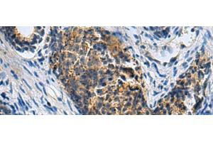 Immunohistochemistry of paraffin-embedded Human prost ate cancer tissue using PLIN4 Polyclonal Antibody at dilution of 1:50(x200) (PLIN4 抗体)