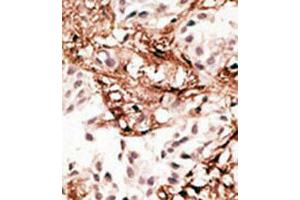 Immunohistochemical staining (Formalin-fixed paraffin-embedded sections) of human breast cancer tissue with MAP1LC3C polyclonal antibody  at 1:50-100 dilution. (LC3C 抗体  (AA 1-30))