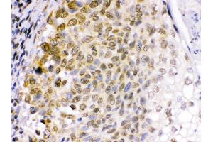 Anti- EME1 Picoband antibody,IHC(P) IHC(P): Human Lung Cancer Tissue (Crossover junction endonuclease EME1 (EME1) (AA 520-561), (C-Term) 抗体)