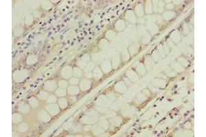 Immunohistochemistry of paraffin-embedded human colon cancer using ABIN7166731 at dilution of 1:100 (NSUN7 抗体  (AA 1-300))