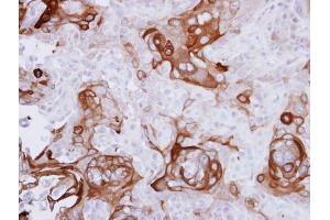 IHC-P Image Immunohistochemical analysis of paraffin-embedded CA922 xenograft, using RPSA, antibody at 1:500 dilution. (RPSA/Laminin Receptor 抗体)