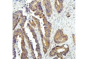 IHC analysis of GLI2 using anti-GLI2 antibody (ABIN6719569). (GLI2 抗体  (AA 721-1457))