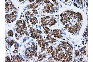 Immunohistochemical staining of paraffin-embedded Carcinoma of liver tissue using anti-ATP5Bmouse monoclonal antibody. (ATP5B 抗体)