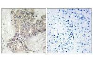 Immunohistochemistry analysis of paraffin-embedded human liver carcinoma tissue using B3GALTL antibody. (B3GALTL 抗体  (C-Term))