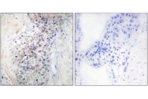 Immunohistochemistry analysis of paraffin-embedded human prostate carcinoma tissue, using LRAT Antibody. (LRAT 抗体  (AA 111-160))
