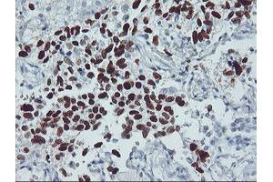 Immunohistochemistry (IHC) image for anti-Tumor Protein P53 (TP53) antibody (ABIN1499973) (p53 抗体)