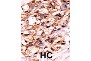 Formalin-fixed and paraffin-embedded human hepatocellular carcinoma tissue reacted with BAD (phospho S118) polyclonal antibody  which was peroxidase-conjugated to the secondary antibody followed by AEC staining.