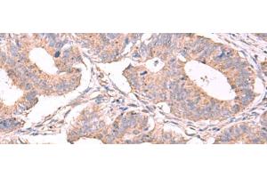 Immunohistochemistry of paraffin-embedded Human colorectal cancer tissue using ESM1 Polyclonal Antibody at dilution of 1:50(x200)