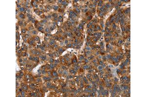 Immunohistochemistry of Human lung cancer using CACNB2 Polyclonal Antibody at dilution of 1:30 (CACNB2 抗体)