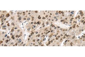 Immunohistochemistry of paraffin-embedded Human liver cancer using TUSC5 Polyclonal Antibody at dilution of 1/40 (TUSC5 抗体)