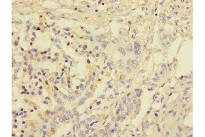 Immunohistochemistry of paraffin-embedded human pancreatic cancer using ABIN7153123 at dilution of 1:100 (FOSL2 抗体  (AA 1-326))