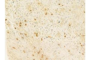 ABIN6261778 and ABIN6278766 at 1/100 staining human prostate carcinoma by IHC-P. (ZFPM2 抗体  (C-Term))