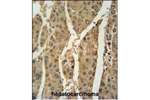PRDX6 Antibody (Center) (ABIN650765 and ABIN2839536) immunohistochemistry analysis in formalin fixed and paraffin embedded human hepatocarcinoma followed by peroxidase conjugation of the secondary antibody and DAB staining. (Peroxiredoxin 6 抗体  (AA 103-132))