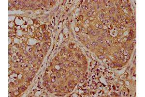IHC image of ABIN7163597 diluted at 1:300 and staining in paraffin-embedded human liver cancer performed on a Leica BondTM system. (PAFAH2 抗体  (AA 1-206))