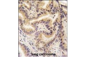 Formalin-fixed and paraffin-embedded human lung carcinoma tissue reacted with RAF1 Antibody   , which was peroxidase-conjugated to the secondary antibody, followed by DAB staining. (RAF1 抗体  (AA 211-240))